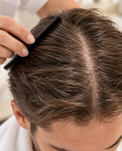 Scalp Treatment for Dry Hair