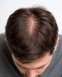 Scalp Treatment for Hair Growth